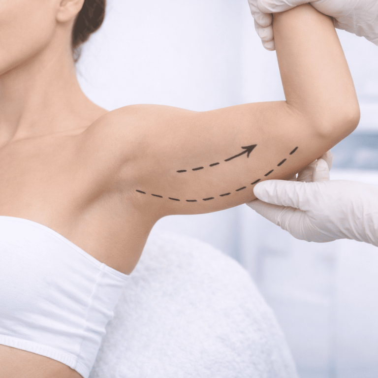 Marcado para cirugía de brazo