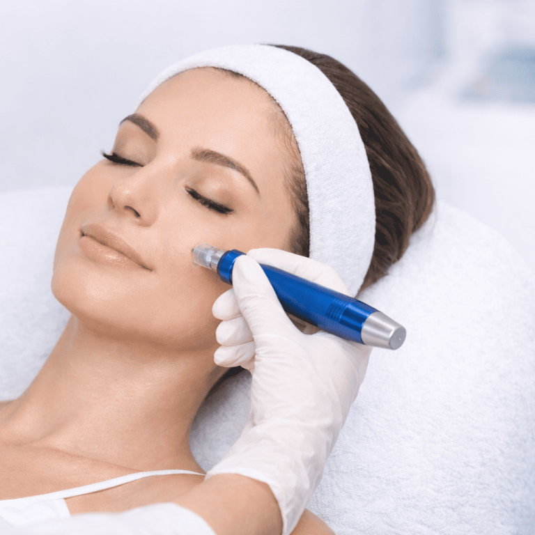 Tratamiento facial con microneedling en progreso